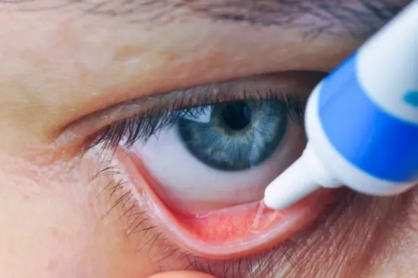 Soin oculaire pour traiter le glaucome, illustrant la prise en charge médicale de la maladie