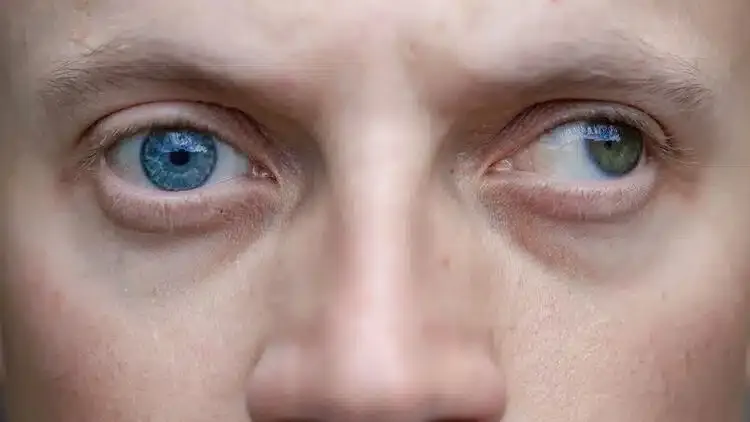 Homme présentant une exotropie, déviation des yeux vers l’extérieur